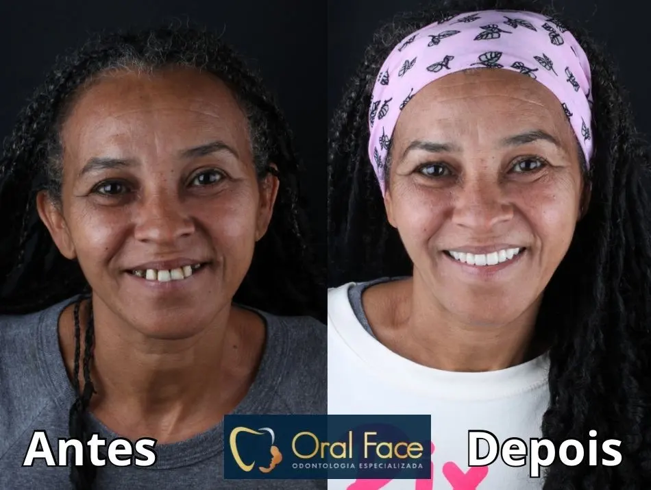 Sorriso de paciente antes e depois do tratamento
