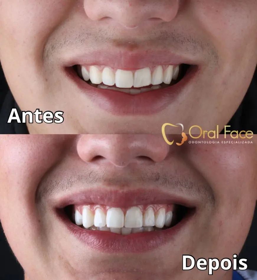 Sorriso de paciente antes e depois do tratamento