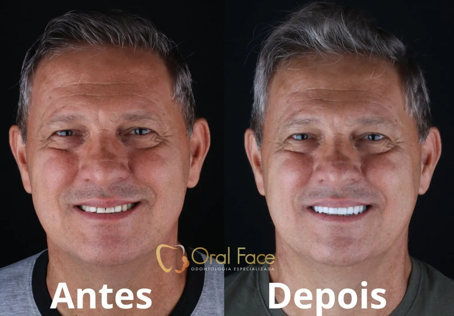 Sorriso de paciente antes e depois do tratamento