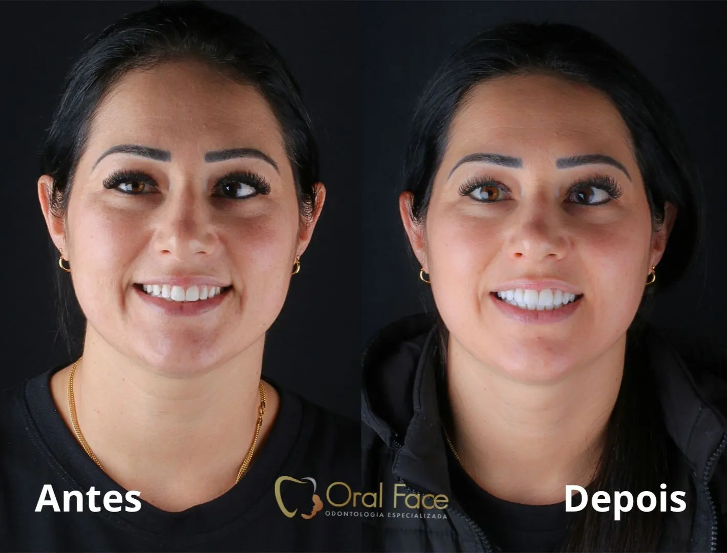 Sorriso de paciente antes e depois do tratamento