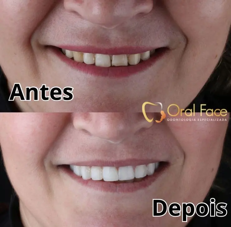 Sorriso de paciente antes e depois do tratamento