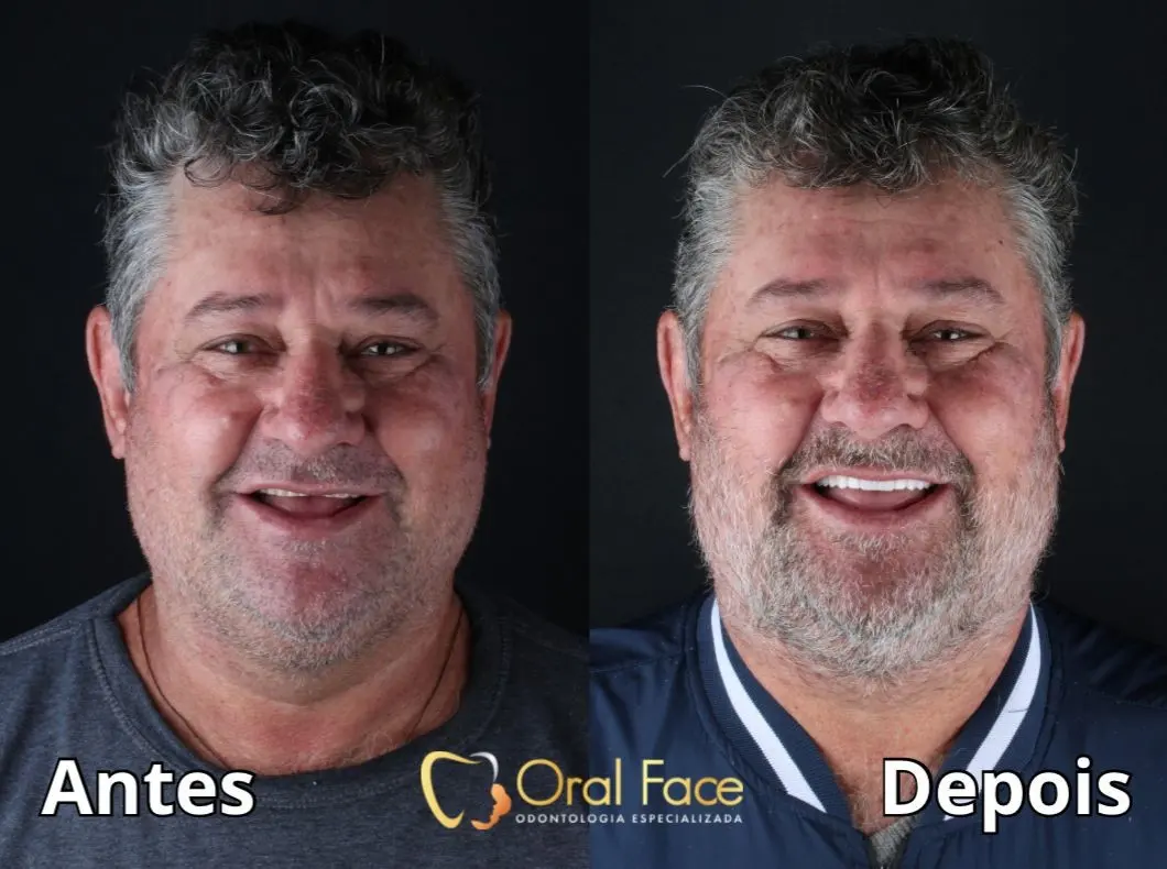 Sorriso de paciente antes e depois do tratamento