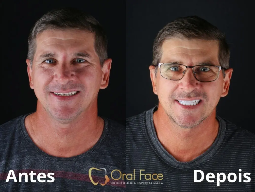 Sorriso de paciente antes e depois do tratamento