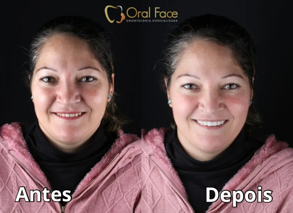 Sorriso de paciente antes e depois do tratamento