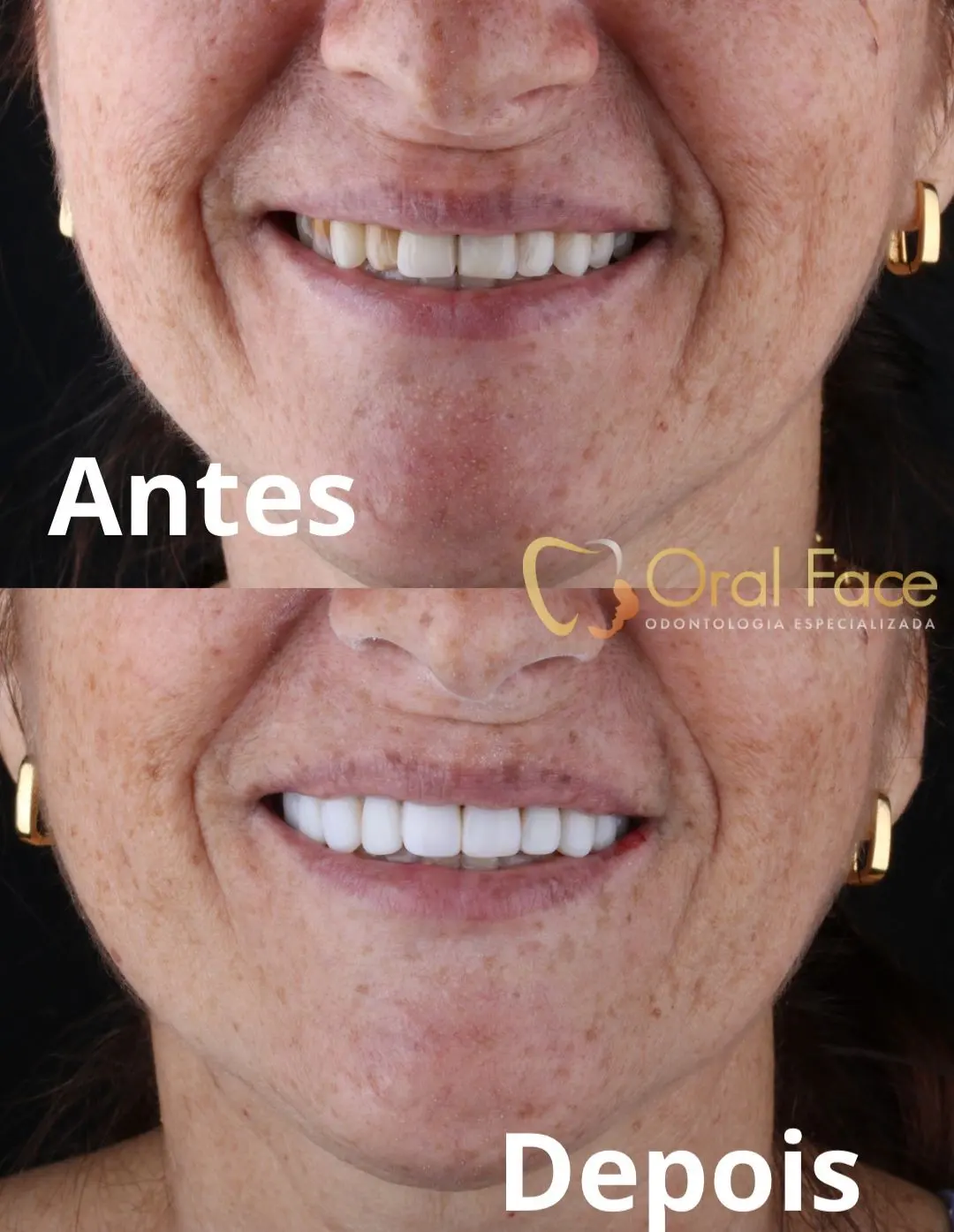 Sorriso de paciente antes e depois do tratamento